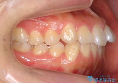 出っ歯　インビザラインで歯を抜かない治療の治療前