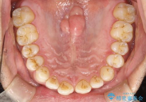歯と歯の間の着色をPMTCでできる限り除去の治療前
