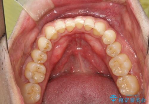 歯と歯の間の着色をPMTCでできる限り除去の治療後