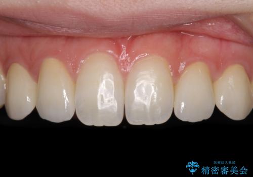 前歯の奇形歯　オールセラミッククラウンによる審美歯科治療の症例 治療後