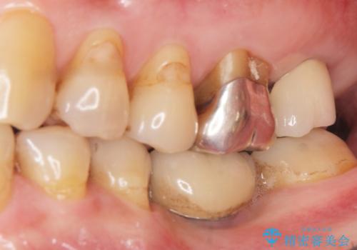 奥歯がわれている　ソケットリフトを併用した奥歯のインプラント　60代男性の治療後