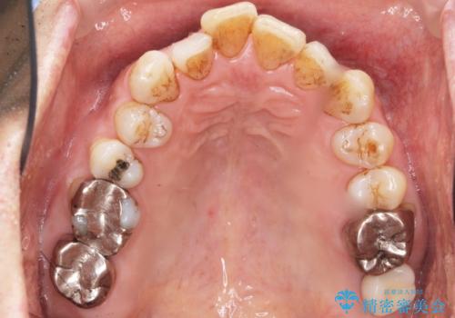 奥歯がわれている　ソケットリフトを併用した奥歯のインプラント　60代男性の治療後