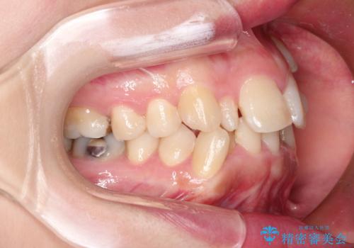 犬歯が変な位置にある　抜歯矯正により正しい位置への治療前