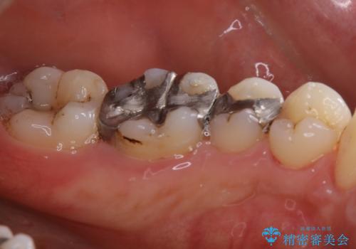 虫歯の治療を始める前にPMTCできれいにの治療後