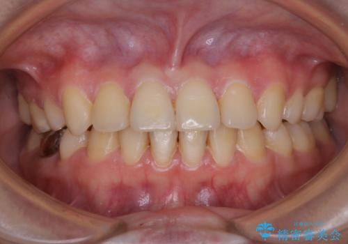 治療の前にPMTCできれいでツルツルな歯にの治療前