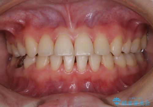 治療の前にPMTCできれいでツルツルな歯にの治療後