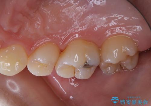 治療の前にPMTCできれいでツルツルな歯にの治療後
