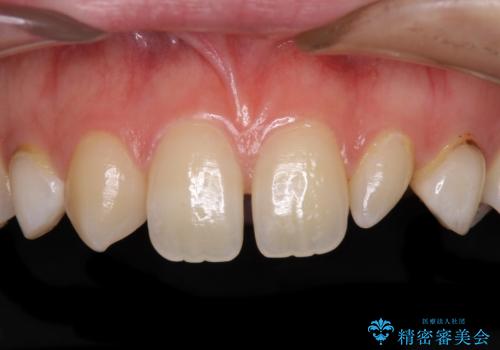 前歯の奇形歯　オールセラミッククラウンによる審美歯科治療の症例 治療前
