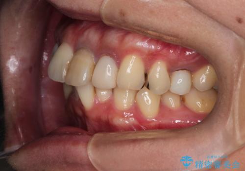 歯並びを含めて前歯をきれいにしたい　インビザラインとセラミック治療の治療前