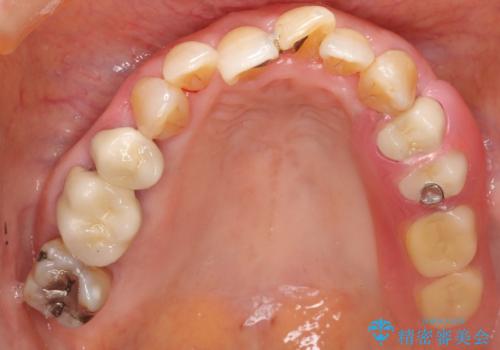 歯ぐきから血が出る、歯ぐきが腫れている　80代女性の治療後