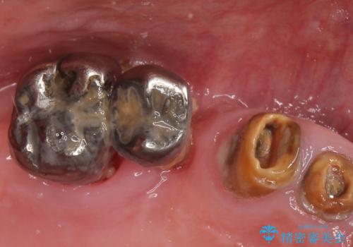 歯がぐらぐら　上顎洞底挙上術を併用した奥歯のインプラント　50代男性の治療前
