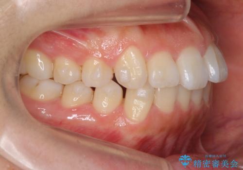 出っ歯　インビザラインで歯を抜かない治療の治療中