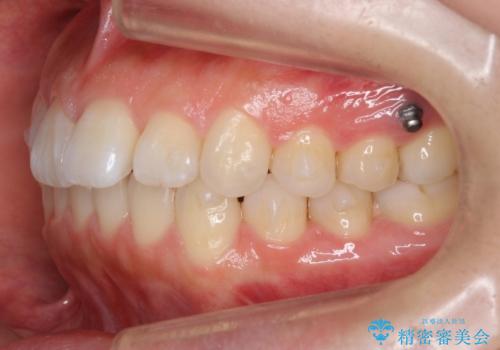 出っ歯　インビザラインで歯を抜かない治療の治療中
