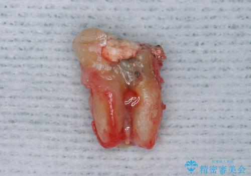 歯が割れた　親知らずの移植　30代女性の治療中