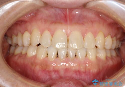 前歯の隙間　インビザラインによる目立たない成人矯正の治療後