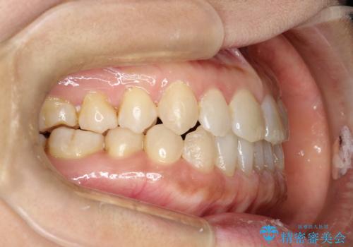 前歯の隙間　インビザラインによる目立たない成人矯正の治療後