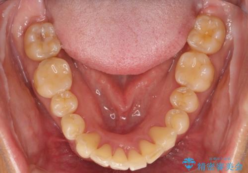 歯並びを含めて前歯をきれいにしたい　インビザラインとセラミック治療の治療後