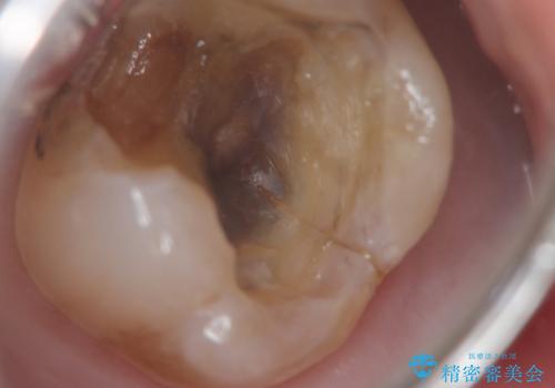 奥歯がわれている　ソケットリフトを併用した奥歯のインプラント　60代男性の治療中