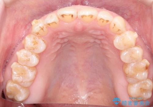 前歯の隙間　インビザラインによる目立たない成人矯正の治療中