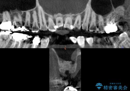 奥歯がわれている　ソケットリフトを併用した奥歯のインプラント　60代男性の治療中