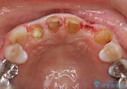 [歯ぐきの腫れを改善]  不適合なセラミッククラウンの治療前