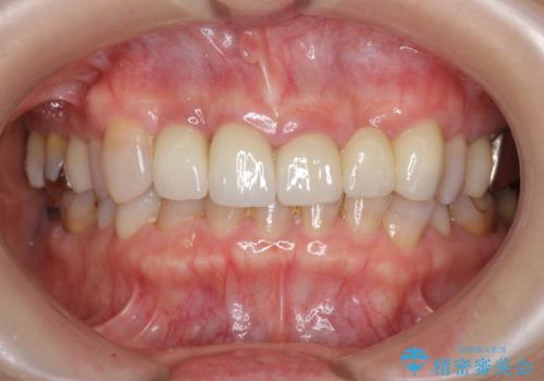 [歯ぐきの腫れを改善]  不適合なセラミッククラウンの治療後