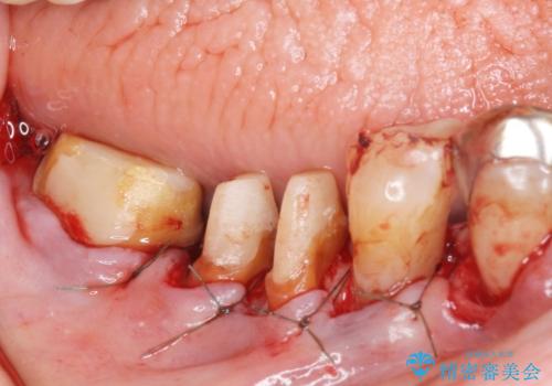 歯ぐきから血が出る、歯ぐきが腫れている　80代女性の治療中