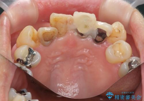 [前歯のグラつき]　根本的な前歯の審美治療を希望の治療前