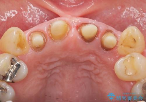 [前歯のグラつき]　根本的な前歯の審美治療を希望の治療中
