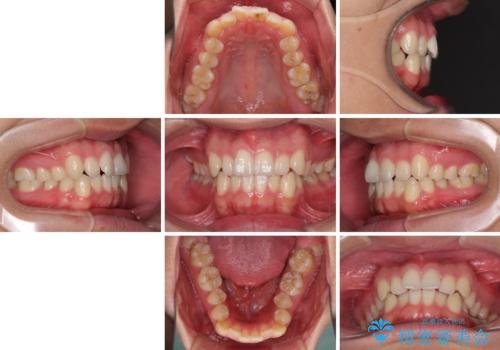 狭い歯列と前歯のデコボコ　インビザラインによる矯正治療の治療前