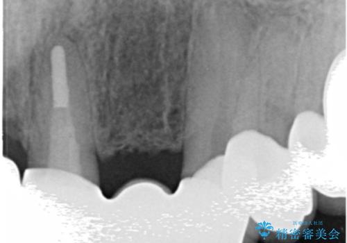 前歯のブリッジの下が虫歯　ブリッジのやりかえの治療後