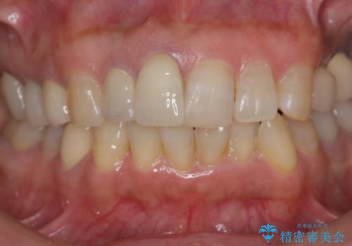 [ジルコニアクラウン]  前歯の見た目を良くしたいの治療後