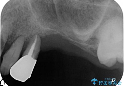 他院でインプラントできないと言われた　上顎洞底挙上術を併用したインプラント　50代男性の治療前