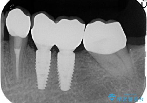[ 2歯連続欠損 ] インプラントによる機能回復　の治療後