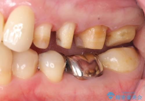 奥歯の被せ物のやり直し　精密根管治療の治療中