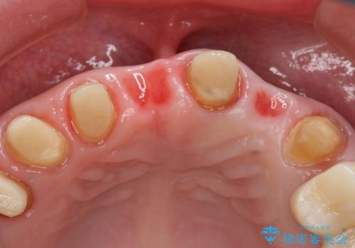 前歯のブリッジの下が虫歯　ブリッジのやりかえの治療中