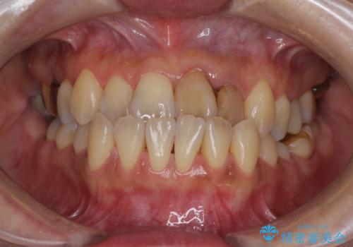 反対咬合で痛む前歯を改善　インビザラインによる矯正治療の症例 治療前
