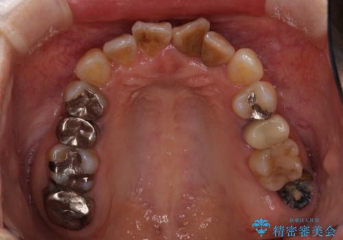 反対咬合で痛む前歯を改善　インビザラインによる矯正治療の治療前
