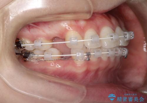 口が閉じにくい　口ゴボの抜歯矯正による改善の治療中