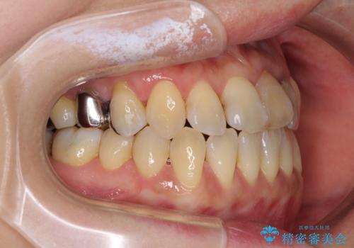 反対咬合で痛む前歯を改善　インビザラインによる矯正治療の治療中