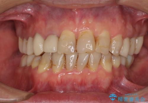 歯列不正と歯周病　総合歯科治療による全顎治療の治療中