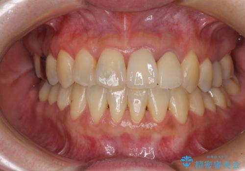 反対咬合で痛む前歯を改善　インビザラインによる矯正治療の症例 治療後