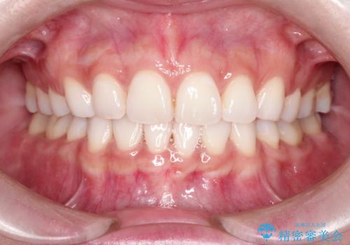 口が閉じにくい　口ゴボの抜歯矯正による改善の治療後