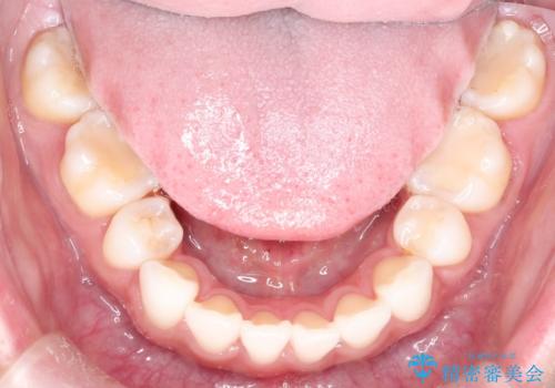 口が閉じにくい　口ゴボの抜歯矯正による改善の治療後