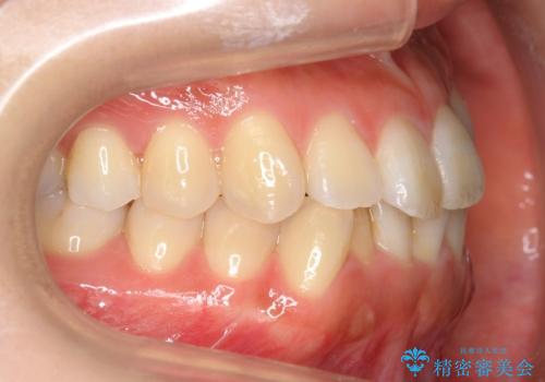 前歯のがたつき　インビザラインで　下の奥歯を後ろに下げるの治療前