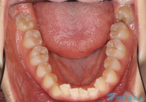 前歯のがたつき　インビザラインで　下の奥歯を後ろに下げるの治療前