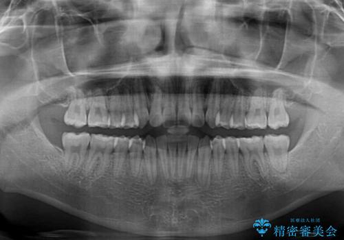 狭い歯列と前歯のデコボコ　インビザラインによる矯正治療の治療後