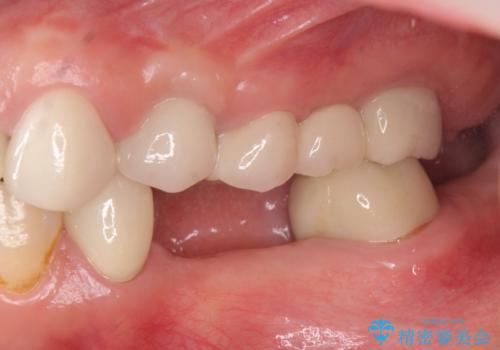 [ 2歯連続欠損 ] インプラントによる機能回復　の治療前