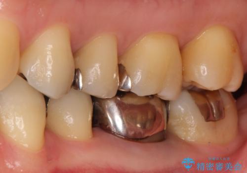 【メタルフリー】白い歯を手に入れたいの治療前