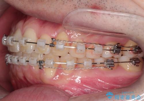 【クリア装置】前歯の凸凹を綺麗にしたいの治療中